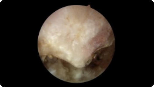 Arthroscopic image of a bone spur