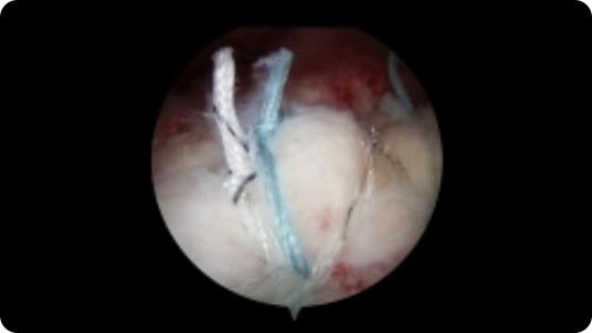 Arthroscopic image of a repaired rotator cuff